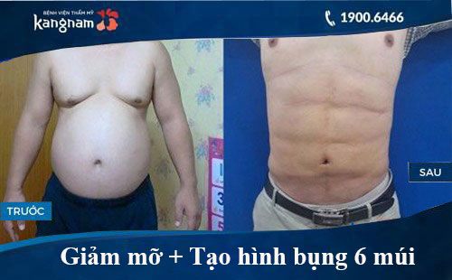 Hình ảnh trước và sau hút mỡ tại kangnam 3