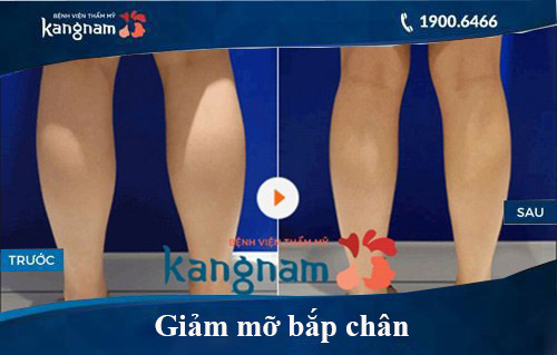 Hình ảnh trước và sau hút mỡ tại kangnam 5