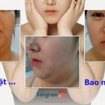 Hút mỡ mặt (má) Kangnam biến mặt to, nhão xệ -> V line chỉ sau 20′ giá bao nhiêu tiền?