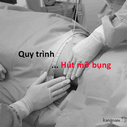 Cận cảnh quy trình hút mỡ bụng diễn ra như thế nào?