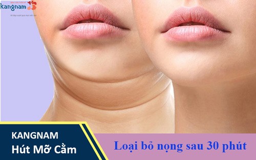 Hút mỡ cằm – Loại bỏ nọng không phẫu thuật, mặt Vline trẻ lại 10 tuổi