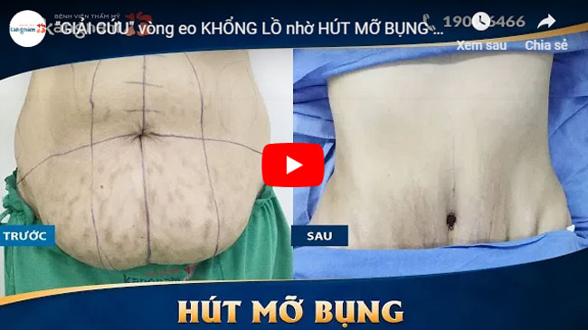 Video hút mỡ bụng