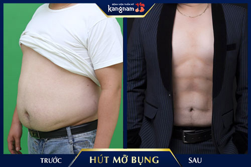 hút mỡ bụng có đau không kangnam