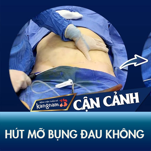 Hút mỡ bụng có đau không? Giải đáp bác sĩ + review khách hàng!