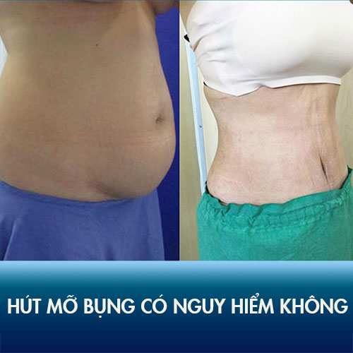 Hút mỡ bụng có nguy hiểm không? Kiểm chứng kết quả khách hàng tại Kangnam!