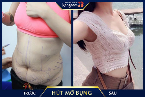 hút mỡ bụng xong có đau không kangnam