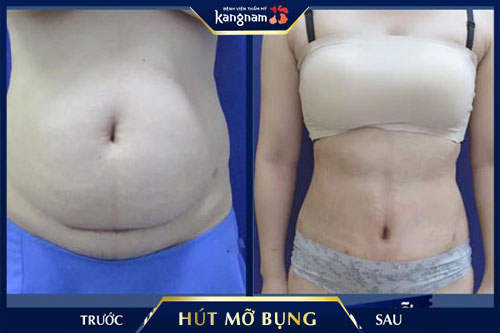 kangnam hút mỡ bụng có đau không