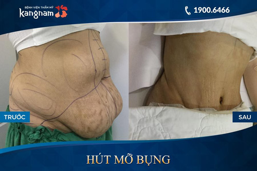 hút mỡ bụng