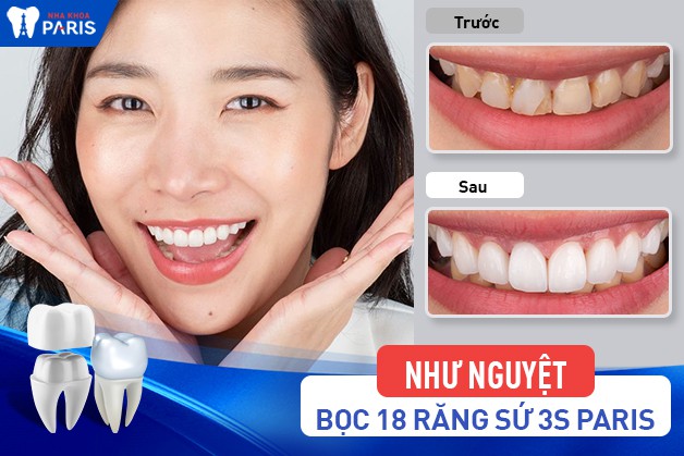 Khách hàng niềng răng an toàn, đạt thẩm mỹ hiệu quả chỉnh nha tại Paris