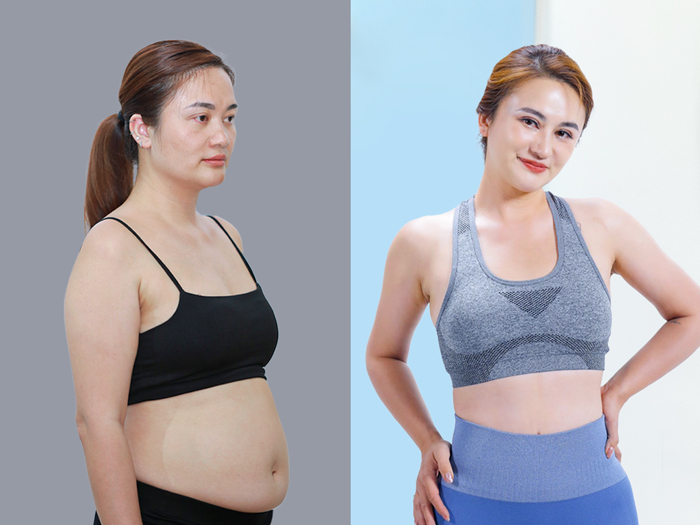 Khách hàng sau hút mỡ tại Kangnam sở hữu vóc dáng thon gọn, cân đối